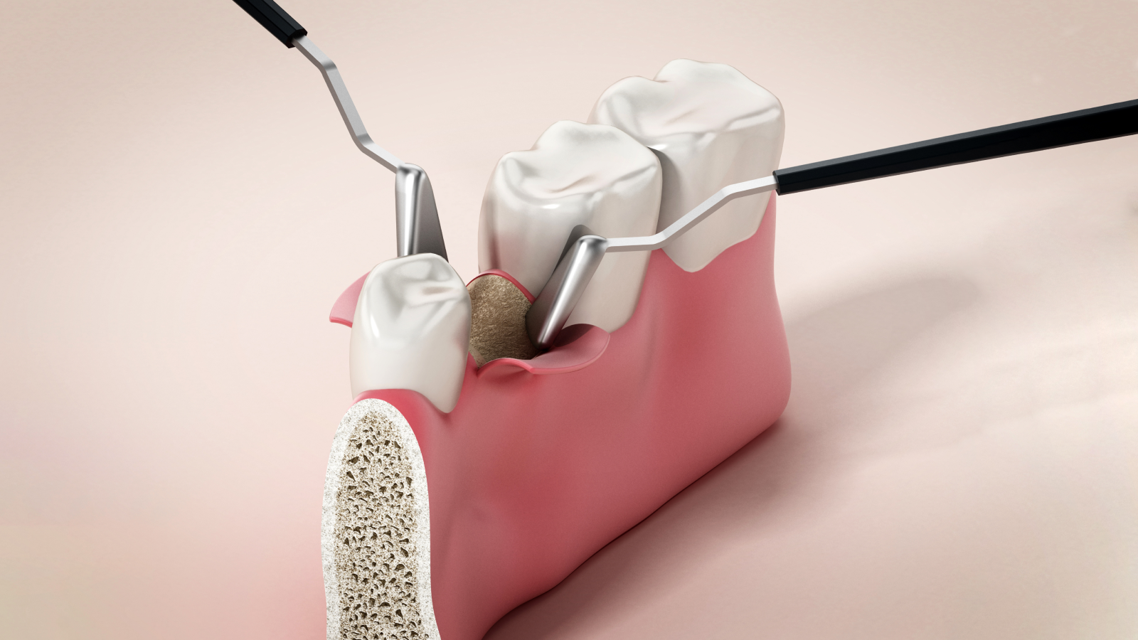 chirurgie orale Chirurgie orale Dr Johan Cinçon - Chirurgien-dentiste à La Teste-de-Buch