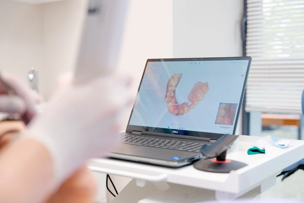 Traitement orthodontique par aligneurs transparents