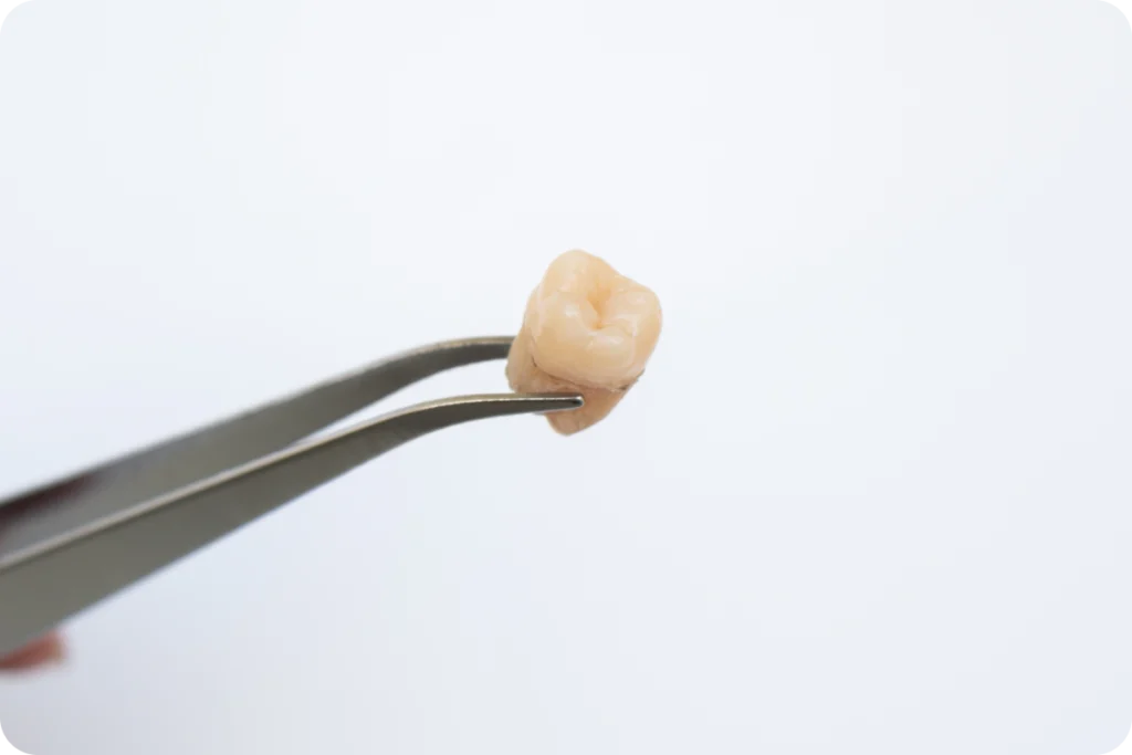 Intervention de chirurgie dentaire complexe au cabinet