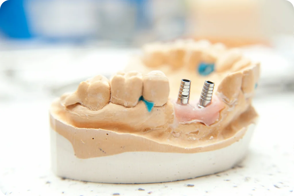 Greffe osseuse & sinus lift