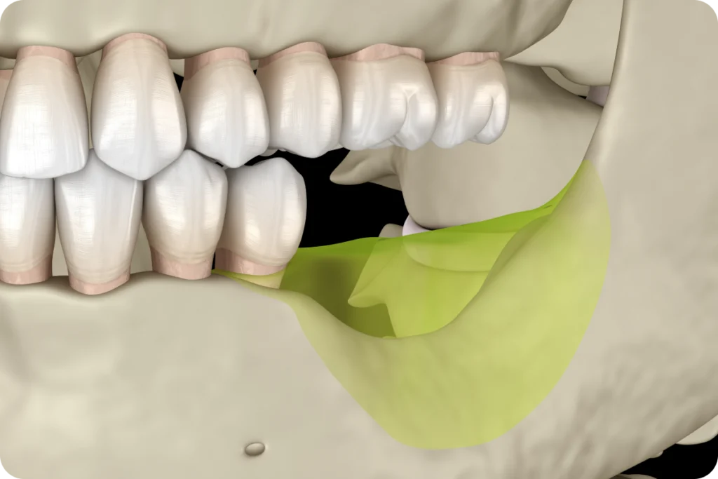 Greffe osseuse préparatoire à la pose d'implants
