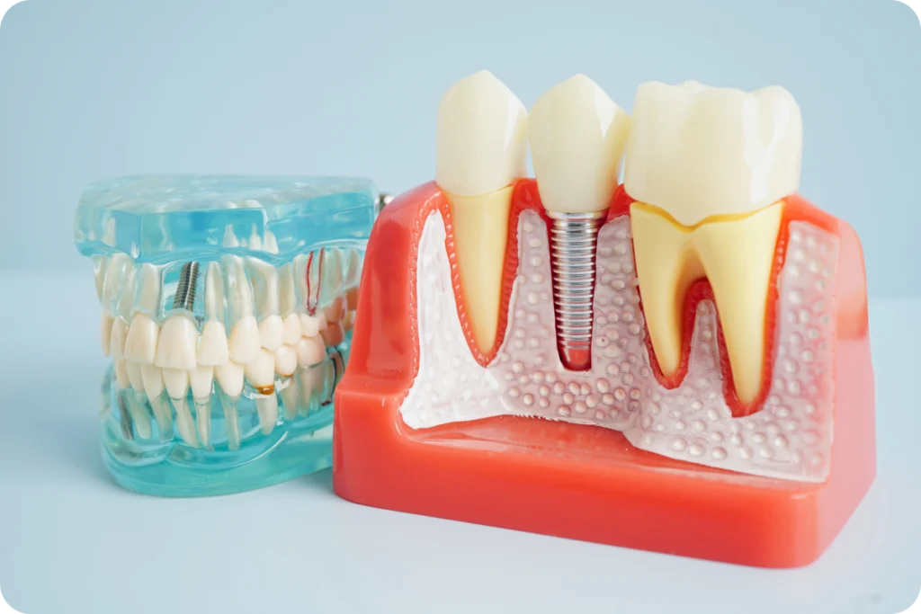 Implant dentaire