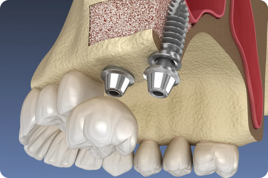 Sinus lift réalisé avant la pose d'un implant