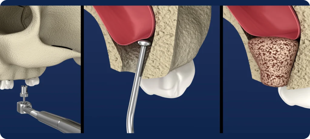 Sinus lift pratiqué par un spécialiste à Angers